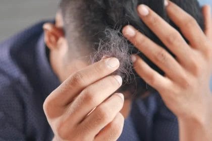 Man Grooming His Hair With Hands And Showing His Hair Loss Problem